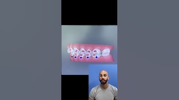 Orthodontist Invisalign Treatment Setup!