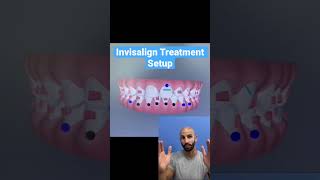 Orthodontist Invisalign Treatment Setup!