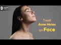 Top Ways to Get Rid of ACNE HOLES | How to fill ACNE HOLES on face?-Dr. Rasya Dixit| Doctors&#39; Circle