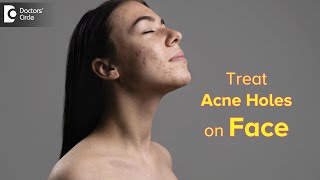 Top Ways to Get Rid of ACNE HOLES | How to fill ACNE HOLES on face?-Dr. Rasya Dixit| Doctors' Circle
