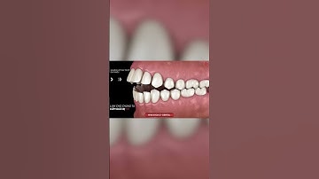 HÔ DO XƯƠNG Có Niềng Răng Hết Được Không? | Nha khoa Sdental #shorts