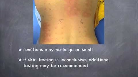 About Allergy Testing