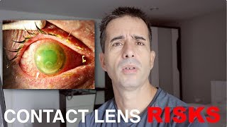 How Dangerous Are Contact Lenses? (& when to wear them anyway) | Endmyopia | Jake Steiner