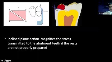 Masterclass on RPD-Principles and design of cast partial dentures with Dr. Rangarajan V