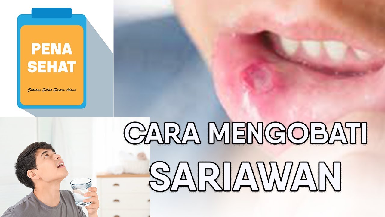 Cara Mengobati Sariawan Catatan Sehat Secara Alami Pena Sehat YouTube