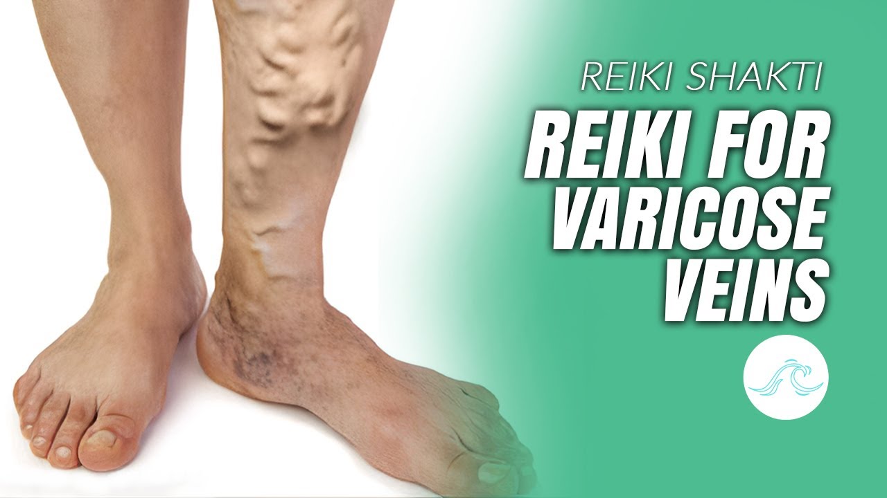 Reiki For Varicose Veins. A Natural Healing Approach