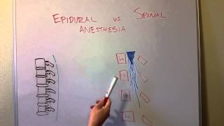 Epidural vs Spinal Anesthesia