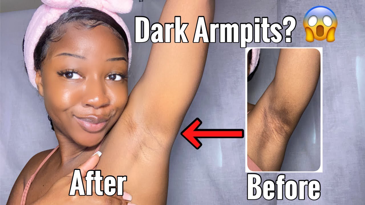 can glutathione whiten underarm HOW TO LIGHTEN YOUR UNDERARMS WITH ONLY 1 PRODUCT!!!