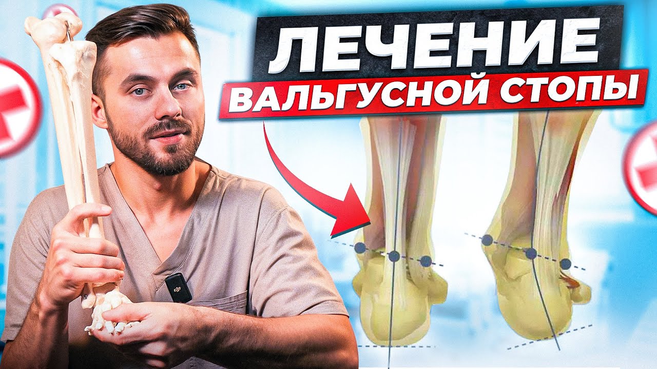 Вальгус Стопы: Эффективное Лечение Без Операции (Упражнения и Профилактика)
