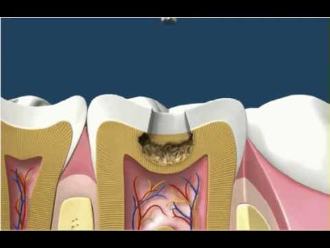 Video: Tandvulling - Moderne Methoden Voor Tandvulling