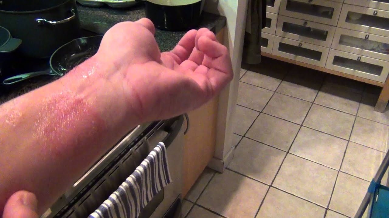 Ringworm And Eczema Nail Polish Cure Part 1 Youtube