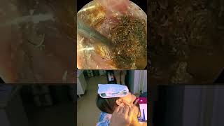 Removing earwax thats mixed with hair