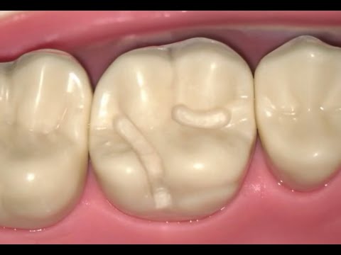 #3 Occlusolingual Amalgam Preparation