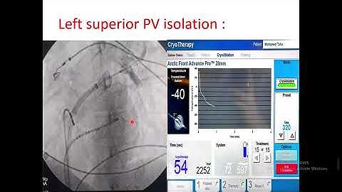 Atrial fibrillation ablation with cryo Under Supervision of Prof Dr, Azza Katta,MD NHI By Dr  Mohame