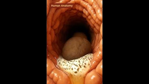 “Real Footage of Constipation Blocking the Colon”