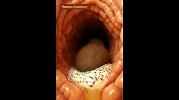 Thumbnail of “Real Footage of Constipation Blocking the Colon”