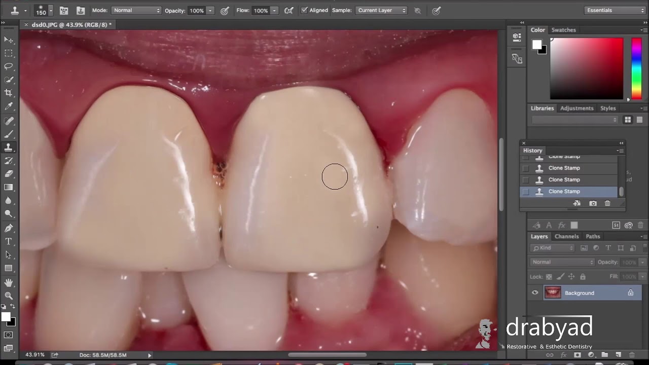 Smile Design For Crown Lengthening Veneer Case Without Templates Using Photoshop Pss Technique