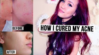 How I Finally Cleared My Skin & Bad Breakouts!
