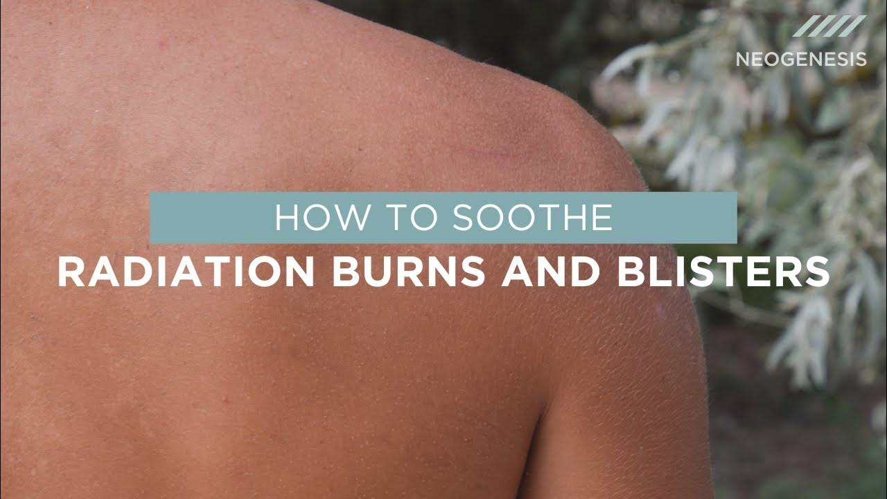 how-to-soothe-radiation-burns-and-blisters-youtube