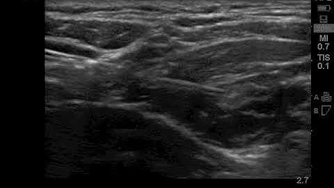 Ultrasound guided Suprascapular nerve block Anterior approach