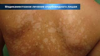 Отрубевидный лишай - лечение, фото, причины, симптомы, народные средства, рецепты и профилактика Отрубевидный лишай - лечение, фото, причины, симптомы, народные средства, рецепты и профилактика