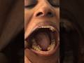 Most teeth in the mouth - 38 by Kalpana Balan 🇮🇳