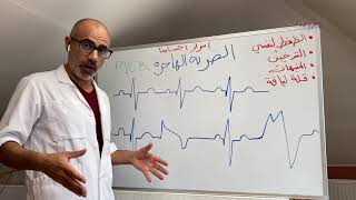 ٣-الضربة الهاجرة في تخطيط القلب ECG. المريض يشخصها#وليد_سرحان #دكتور_عراقي #ECG #الطب
