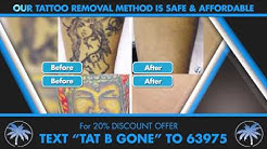 St Pete Tattoo Removal Pinellas Park FL St. Pete FL Clearwater FL | http://StPeteTattooRemoval.com 