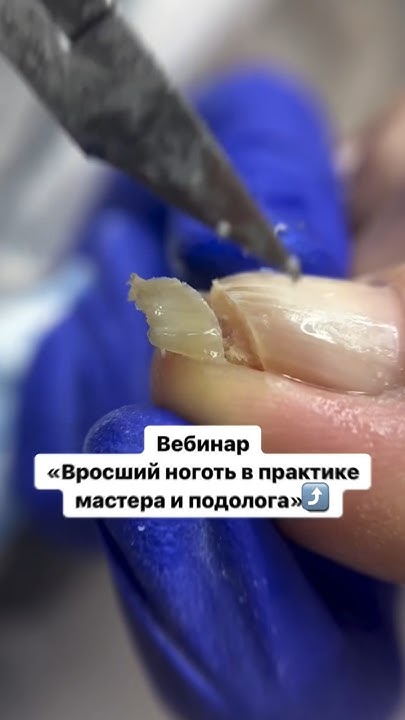 Вросшие ногти — боль многих клиентов в последнее время😰 Подробнее про ...