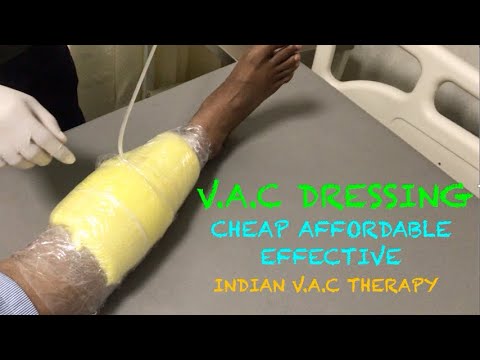 V.A.C DRESSING | CHEAPEST & MOST EFFECTIVE V.A.C DRESSING | Vacuum Assisted Wound Healing Treatment