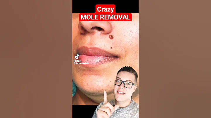 CRAZY MOLE REMOVAL - It Just Disappears #shorts - DayDayNews