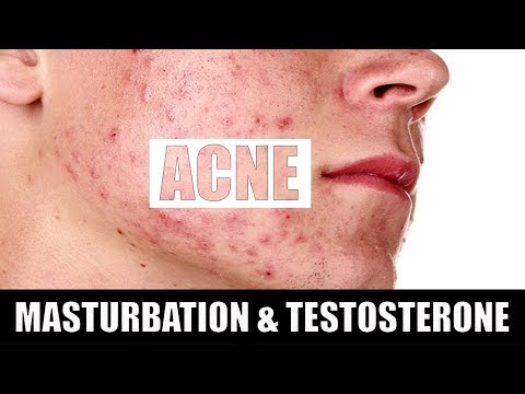 MASTURBATION or SEX (सेक्स या मैथुन) causes Acne? TESTOSTERONE boost [SCIENCE]