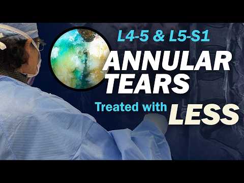 61-Year-Old, an Engineer of WiFi, Annular Tears Treated with LESS