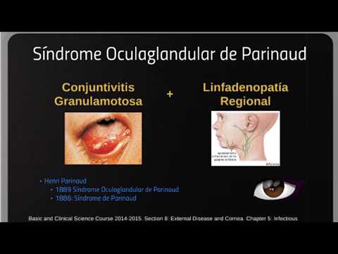 Síndrome oculoglandular de Parinaud por Ronit Alvarado