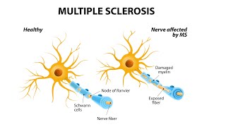 التصلب اللويحي  |  Multiple sclerosis