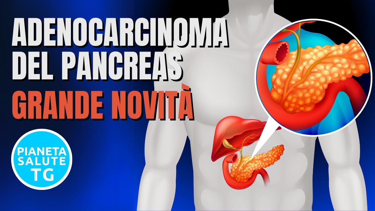 Nuove Speranze nel Trattamento dell'Adenocarcinoma del Pancreas: Irinotecano Liposomiale Pegilato