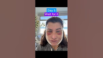 EPIC FACELIFT TRANSFORMATION (Journey)