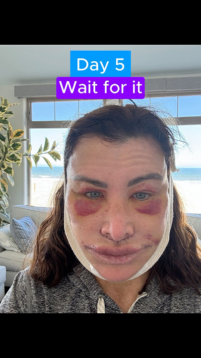 EPIC FACELIFT TRANSFORMATION (Journey)
