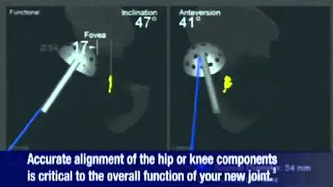 Computer Assisted Orthopaedic Hip Knee Replacement...