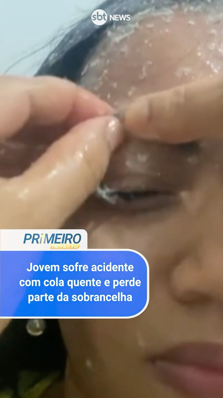 Jovem sofre acidente com cola quente e perde parte da sobrancelha