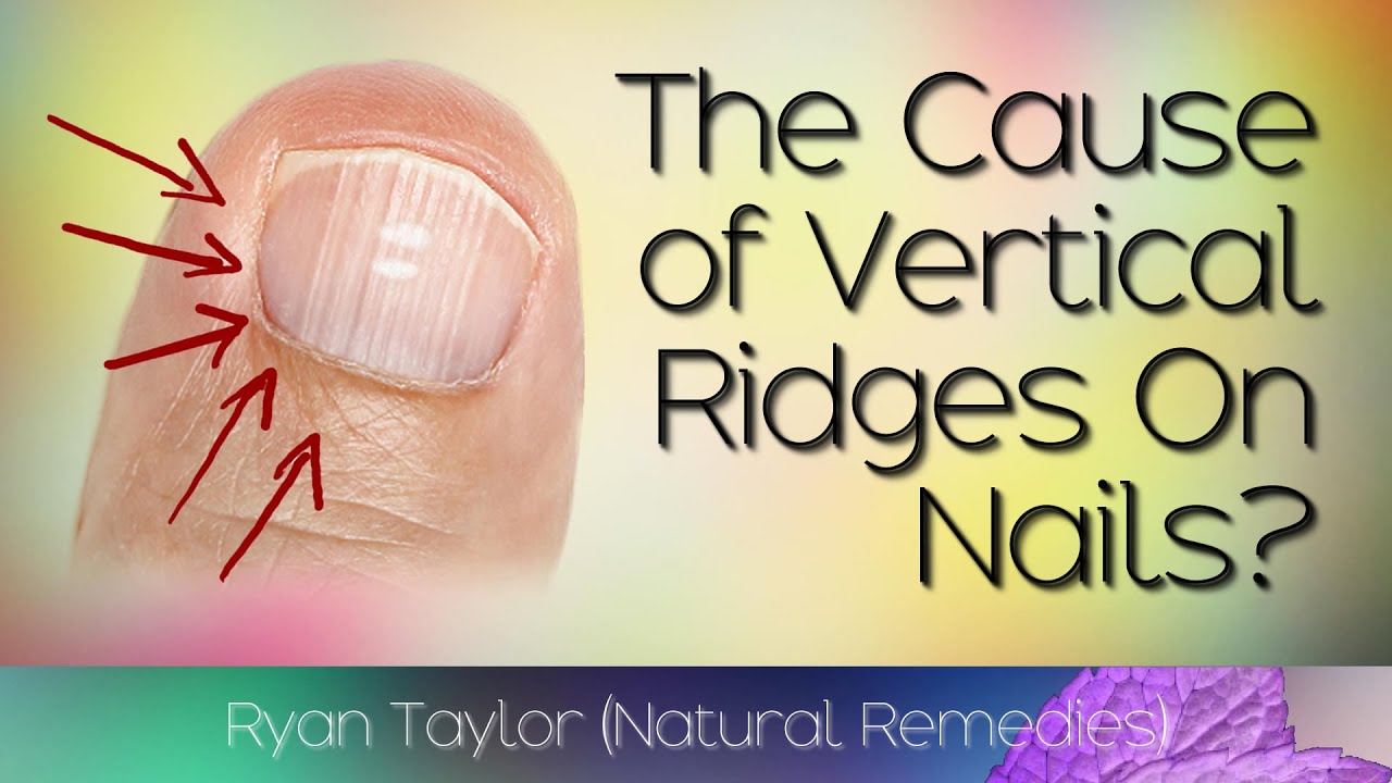 Do You Have Vertical Ridges On Your Nails? (Cause) - YouTube