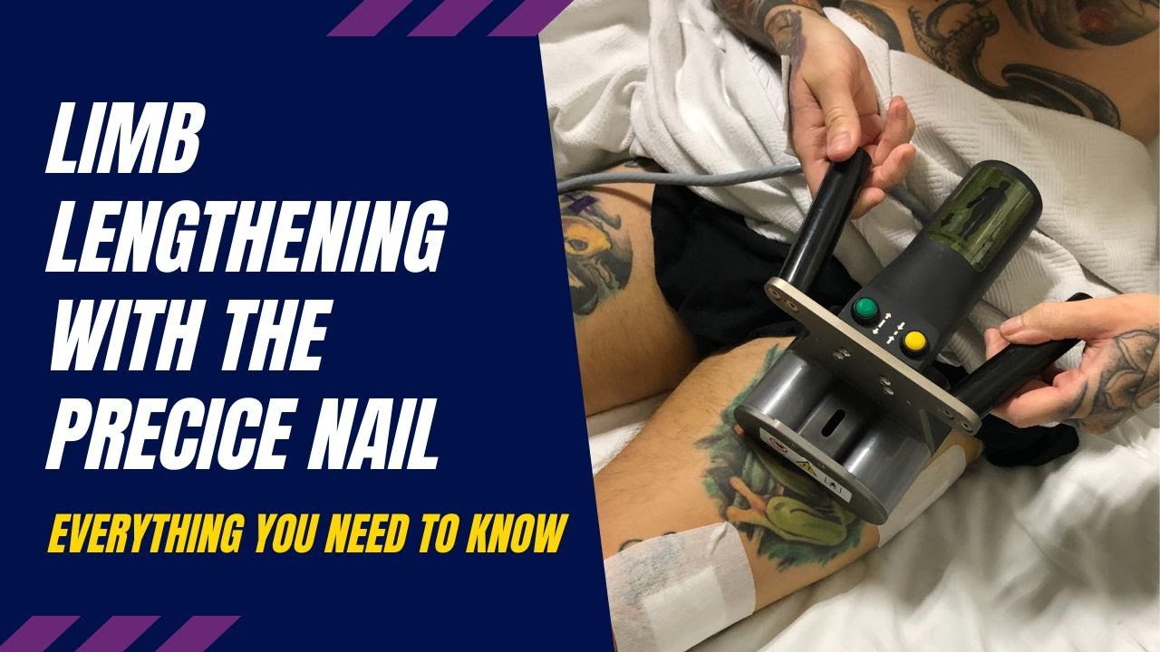 The Precice Intramedullary Limb Lengthening System Everything You