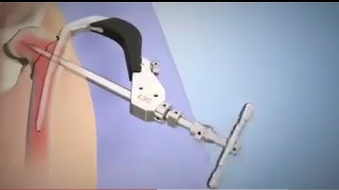 Intramedullary fixation using the TFN-Advanced (TFNA) proximal femoral nailing system