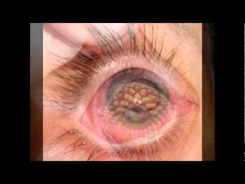 eye disease