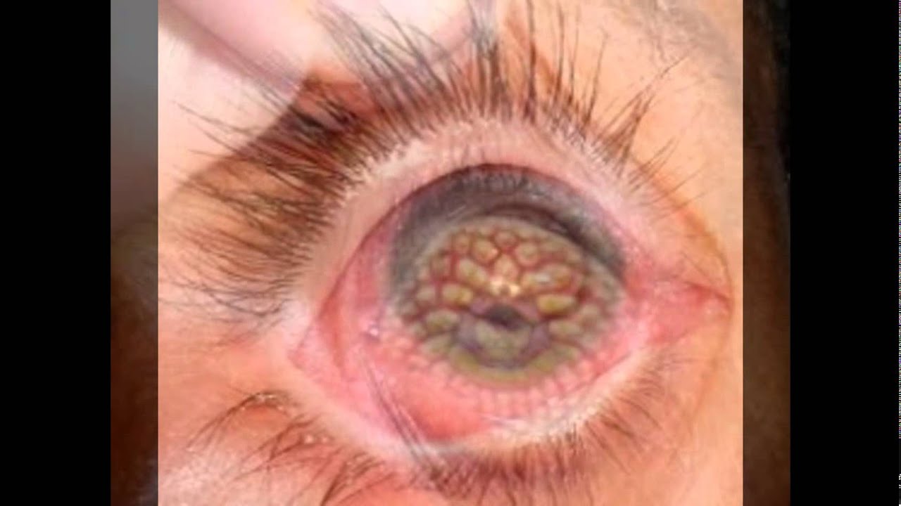 Disease Of The Eye YouTube