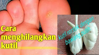 Cara Ampuh Menghilangkan KUTIL Dengan Bawang Putih