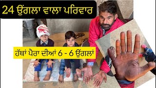 Shocking 24 finger family all member having 12 in hand and 12 in foot finger in punjab