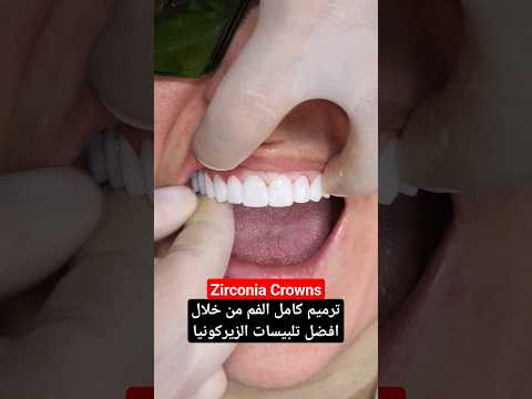 تلبيسات زيركونيا للحصول على اجمل ابتسامة وابتسامة هوليود