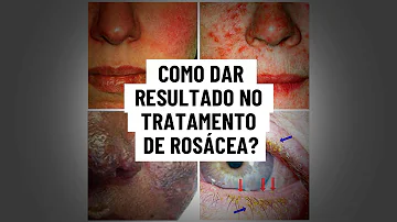 O que fazer para eliminar a rosácea?