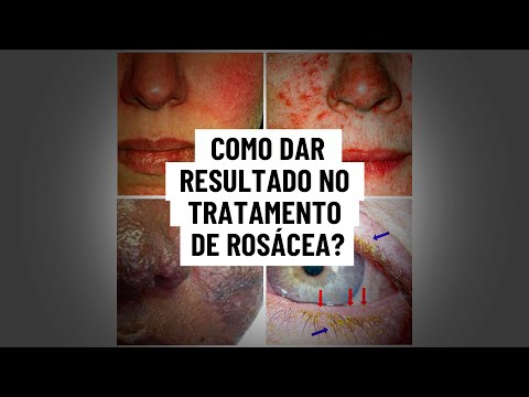 Vídeo: Como Tratar O Líquen Rosácea Em Uma Criança